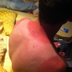 Sonnenbrand auf dem Rücken