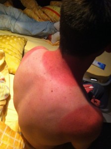Sonnenbrand auf dem Rücken