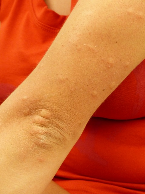 Hives Pictures and Information - Verywell